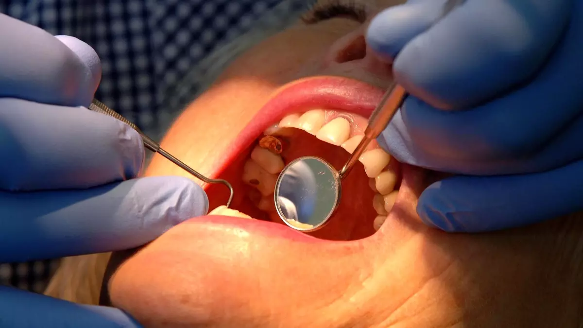 nottingham universitesinden dis minesini onaran yeni jel RnGuazi2.jpg