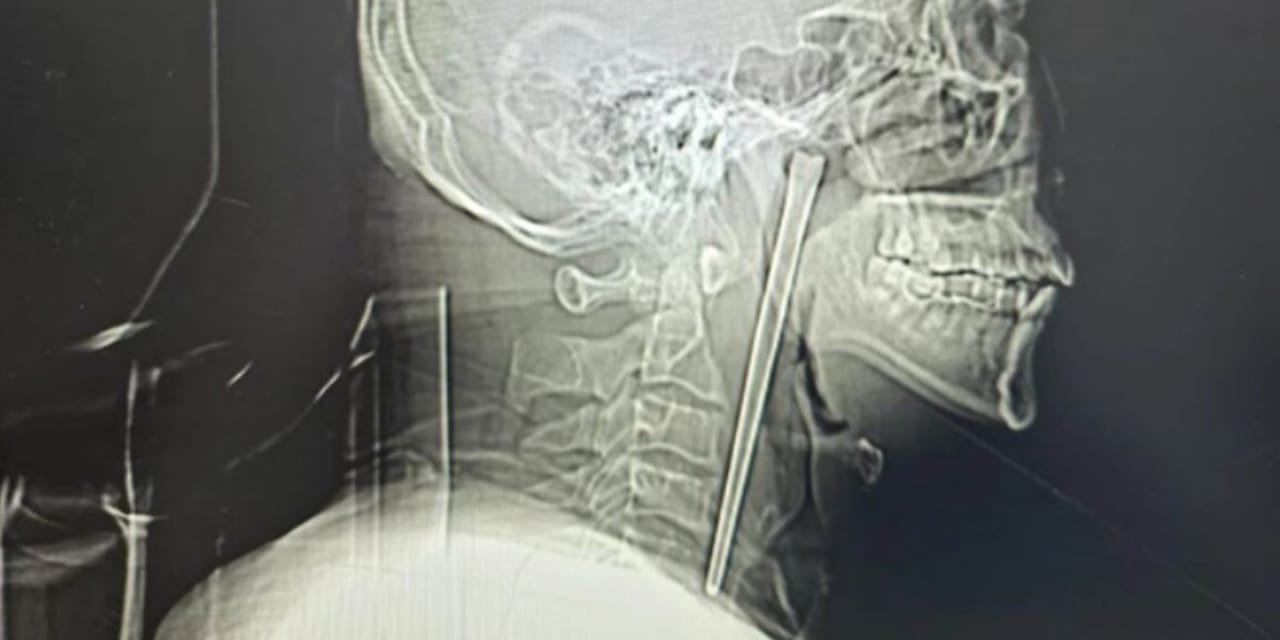12 Santimetrelik Metal Çubukla 8 Yıl Yaşayan Adamın Şaşırtıcı Hikayesi